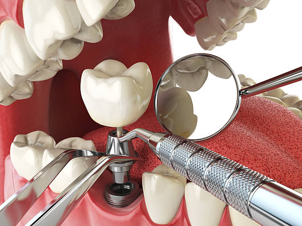 Best Emergency Dentist for Lost Fillings or Crowns in Pecos, TX